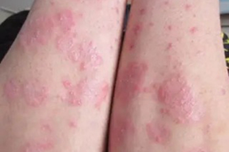 点滴型副银屑病胳膊丘疹图 点滴型副银屑病胳膊丘疹图