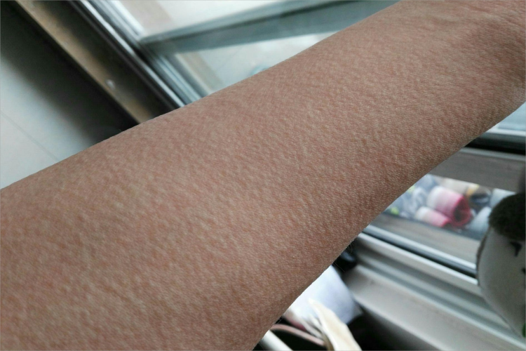 胆碱能性荨麻疹小疙瘩图