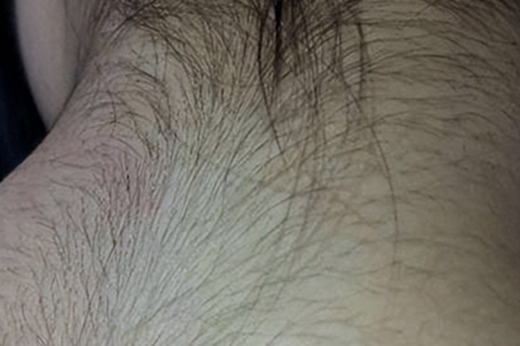 妇女多毛症后颈症状图