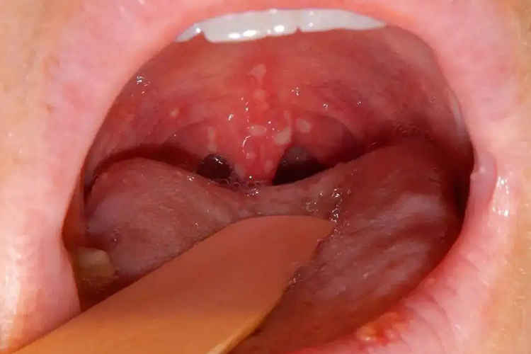 疱疹性咽峡炎咽腭弓疱疹图 疱疹性咽峡炎咽腭弓疱疹图