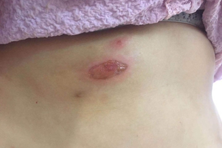 脓疱疮背部症状图