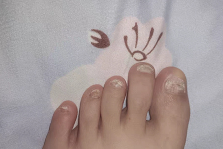 全甲损毁型甲真菌病脚趾甲缺损图