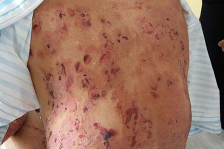 疱疹样天疱疮腰部黑痂图