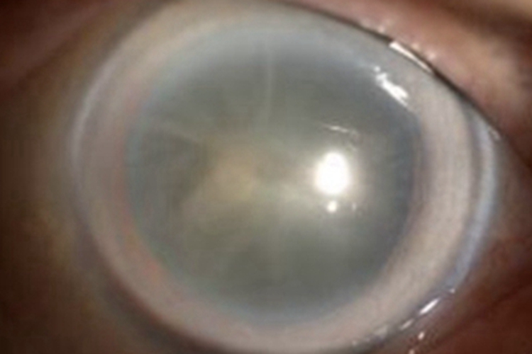 全白内障症状图