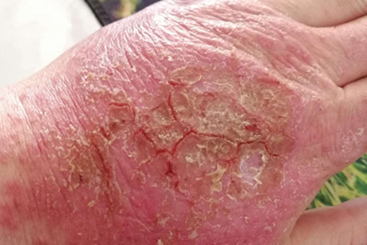 皲裂性湿疹红肿图