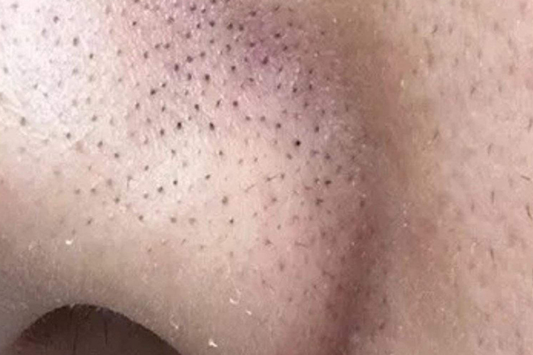 小棘毛壅病图