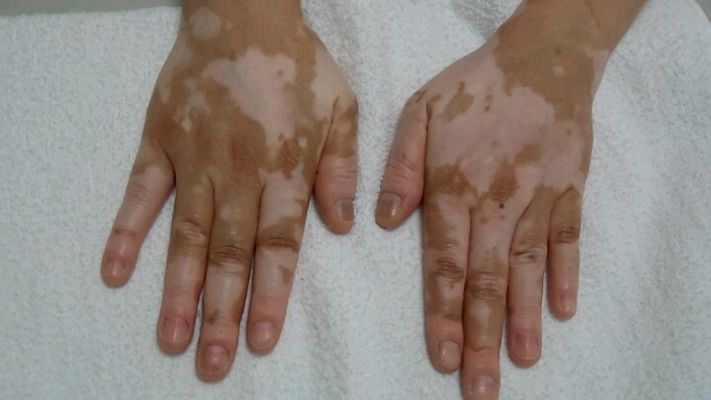 手部白癜风图