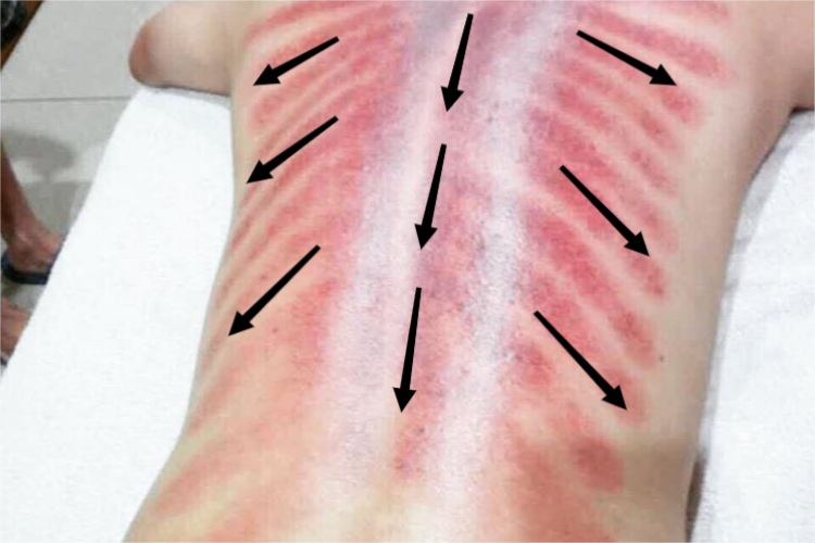 刮痧方向示意图