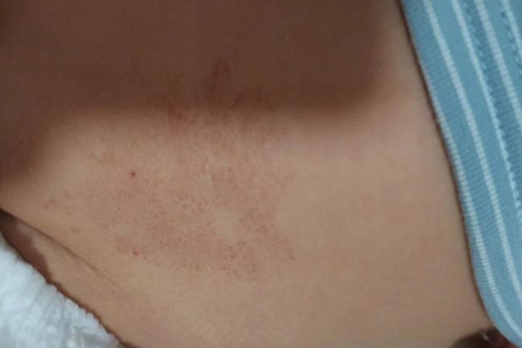 血管瘤液氮冷冻浅表疤痕图