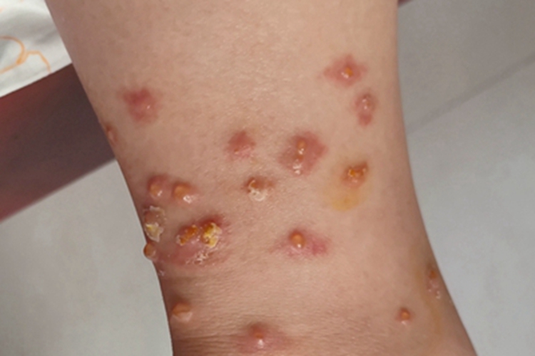 严重的丘疹性荨麻疹图