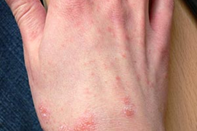 色素性痒疹手背出现红斑图 色素性痒疹手背出现红斑图