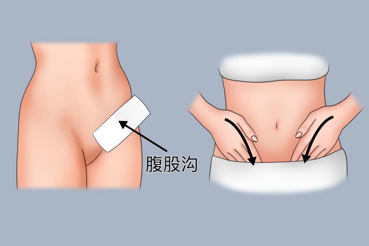 酒精擦浴腹股沟图