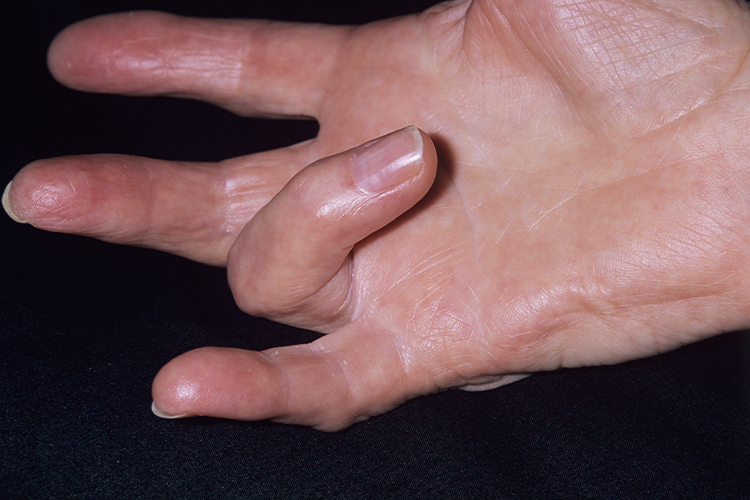 指屈肌腱损伤图 指屈肌腱损伤图