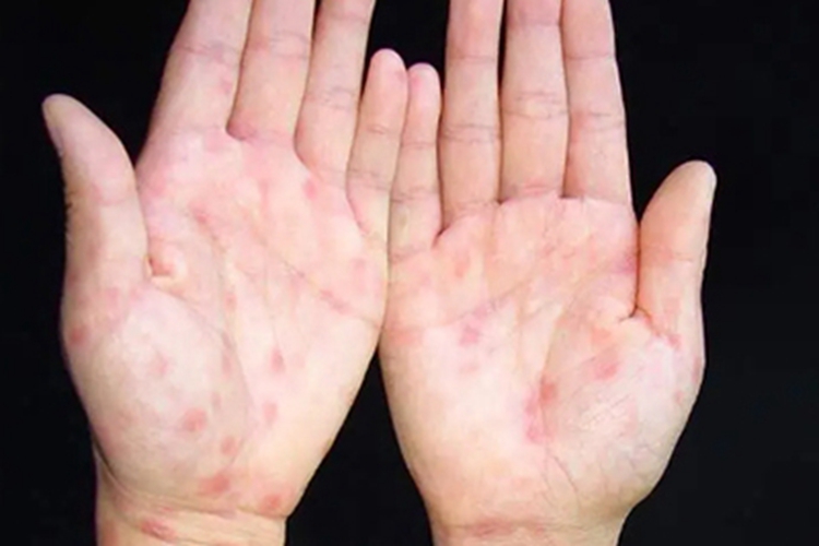 女性二期梅毒手部小红疙瘩图