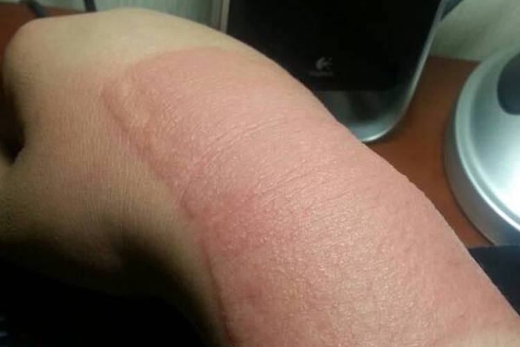 贴膏药过敏图 贴膏药过敏图