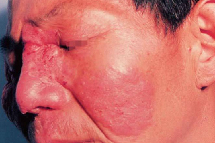 镰刀菌病面部红斑图 镰刀菌病面部红斑图