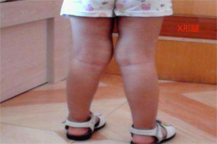 佝偻病X形腿图