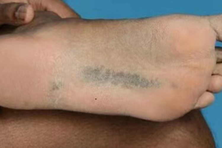 扁平苔藓脚底皮肤发黑图 扁平苔藓脚底皮肤发黑图