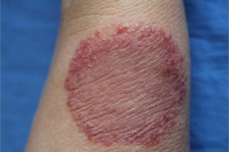 体癣胳膊红斑结痂图