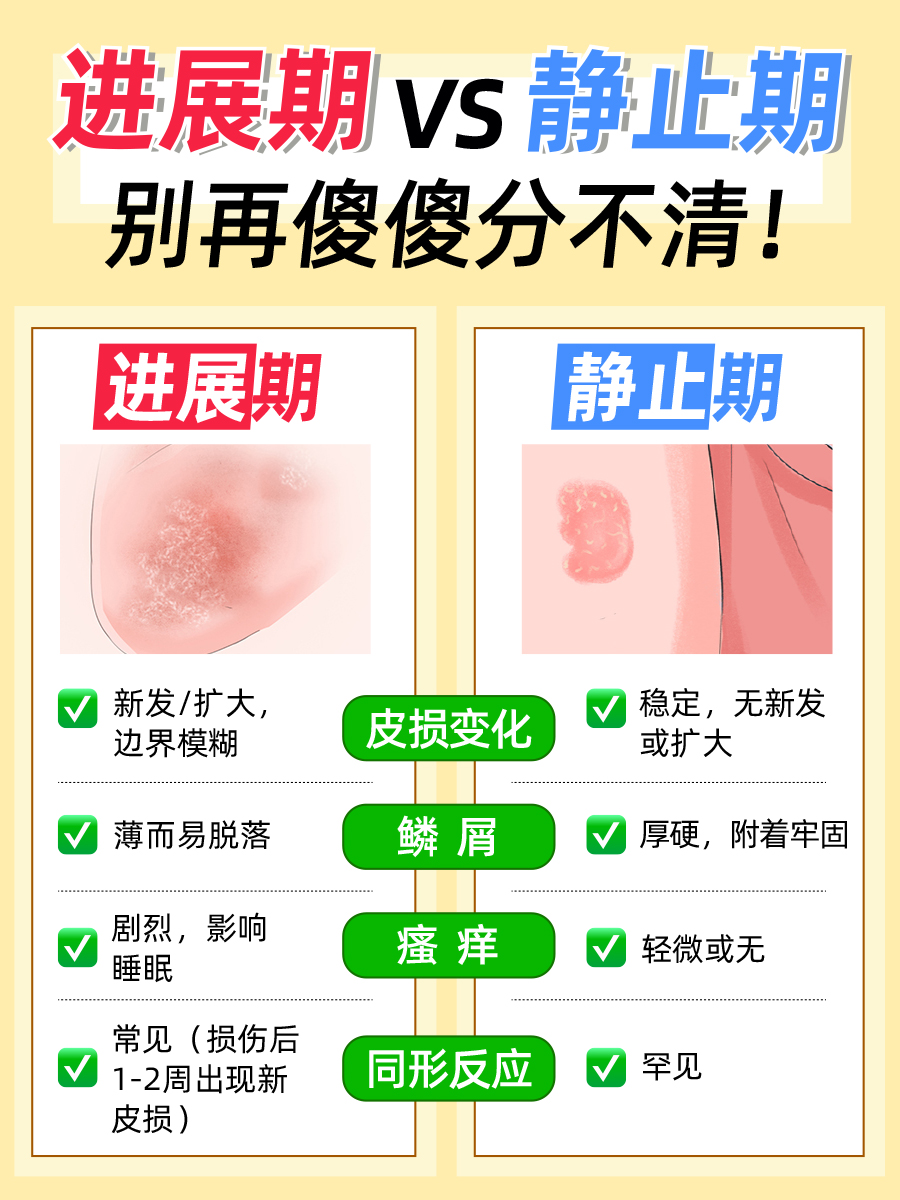 银屑病的进展期有哪些表现，一文理清楚！