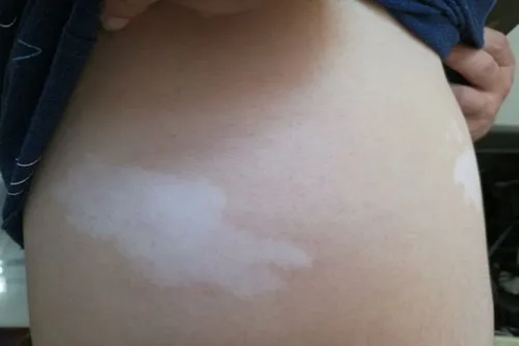 婴儿腰腹白色胎记图 婴儿腰腹白色胎记图