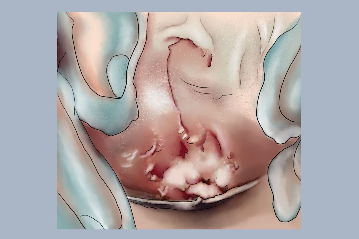 假性湿疣绒毛状皮损图