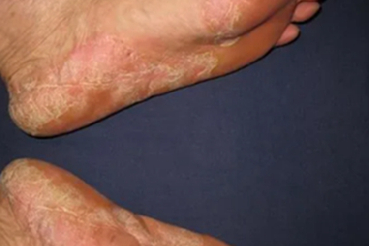 慢性湿疹脚底图