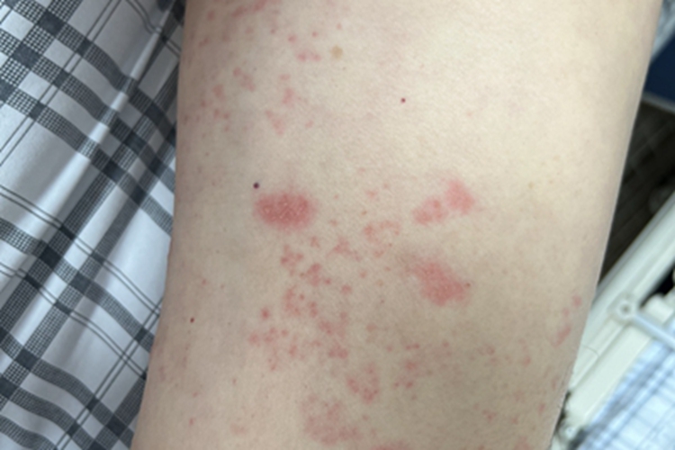 带状疱疹红斑图