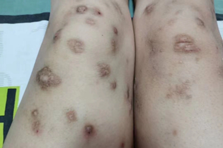 痒疹腿斑图 痒疹腿斑图