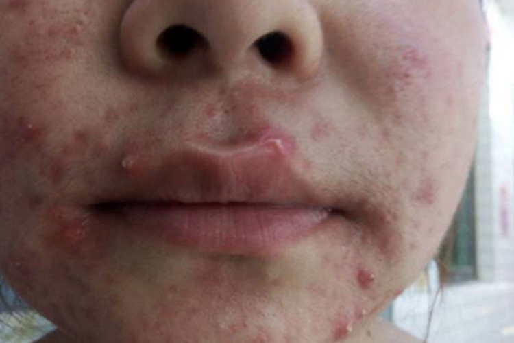 丘疹脓疱型玫瑰痤疮脓包图