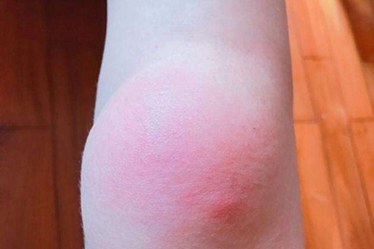 骨肉瘤膝盖红肿图