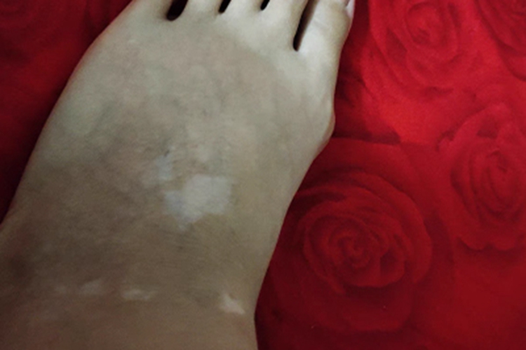 进展期节段型白癜风脚背白斑图