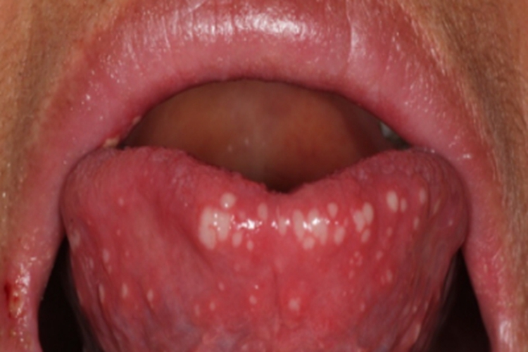 疱疹样溃疡症状图 疱疹样溃疡症状图