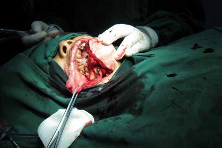 下颌骨开放性骨折图