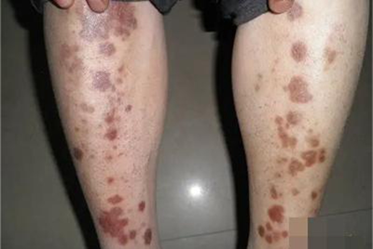 结节性结核性静脉炎长斑图