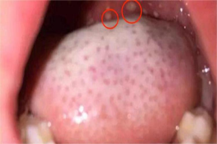 疱疹性咽炎咽喉白点图 疱疹性咽炎咽喉白点图