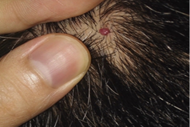 毛囊周围纤维瘤头皮小红疙瘩图