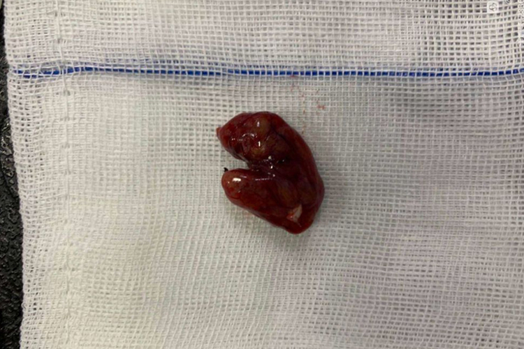 手指神经鞘瘤图