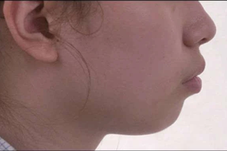 骨性凸嘴双颌前突图