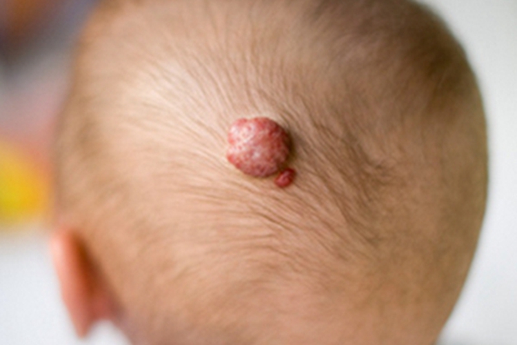 血管瘤头皮疙瘩图