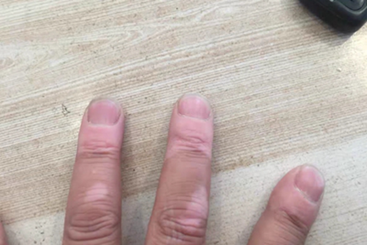 白癜风手指症状图