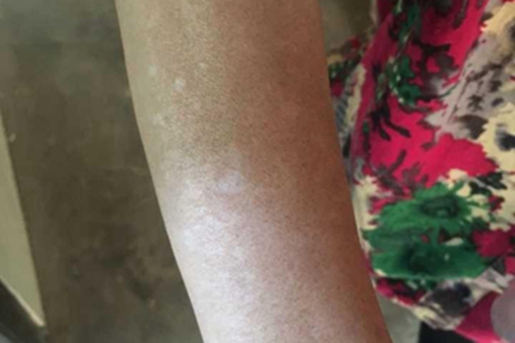 特发性滴状色素减少症胳膊白斑图