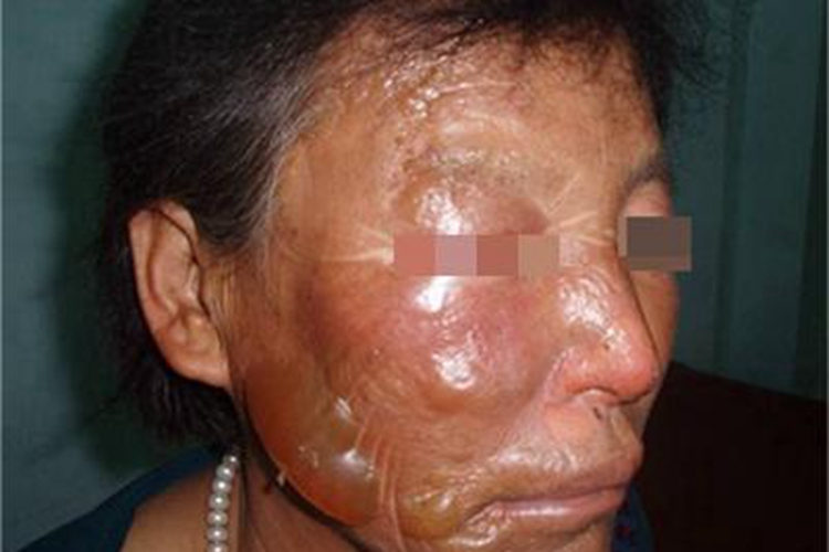 浅Ⅱ度烧伤面部肿胀图