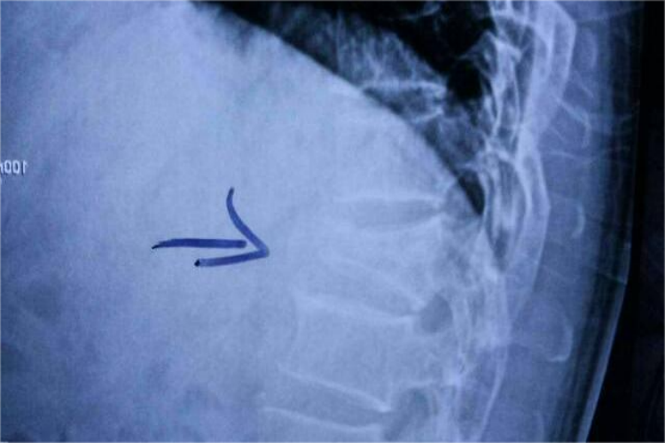 t12胸椎压缩性骨折椎体鱼尾样图
