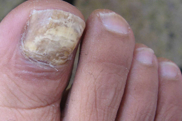 全甲毁损型甲真菌病图