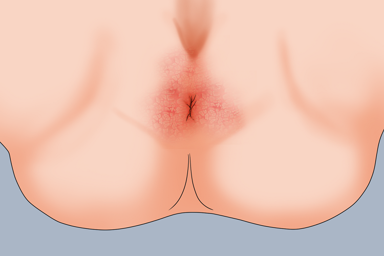 慢性期肛周湿疹皮肤粗糙图