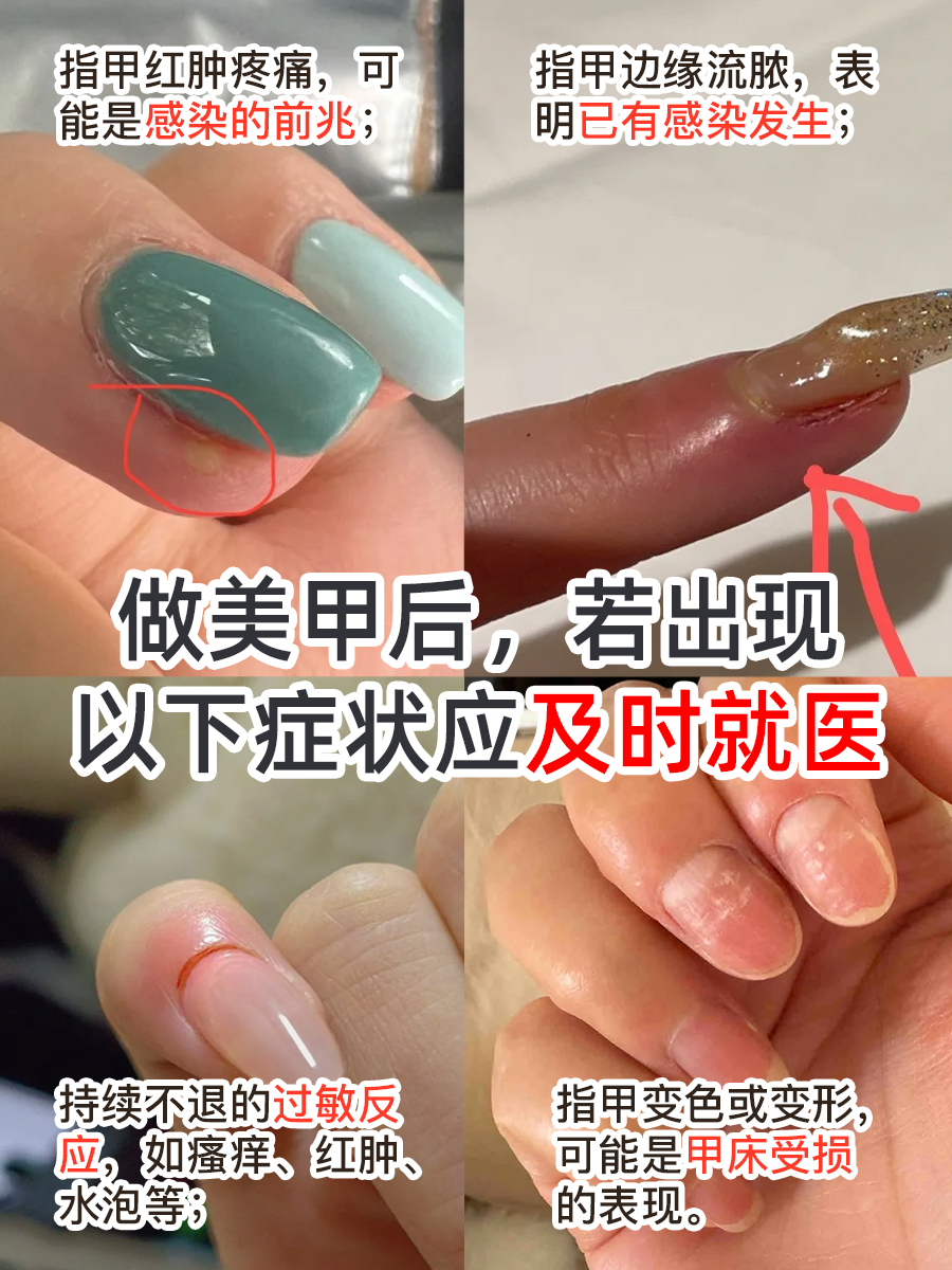 糟糕!美甲连带着指甲掀开了流血了,快来学应对方法!