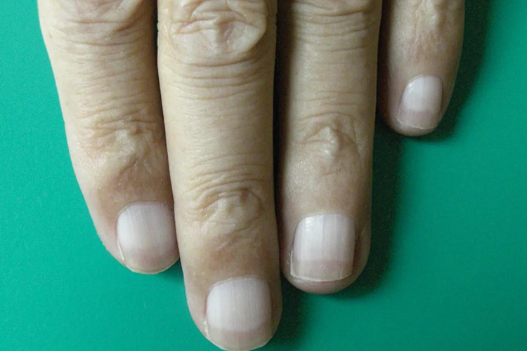 肾不好对半甲图 肾不好对半甲图