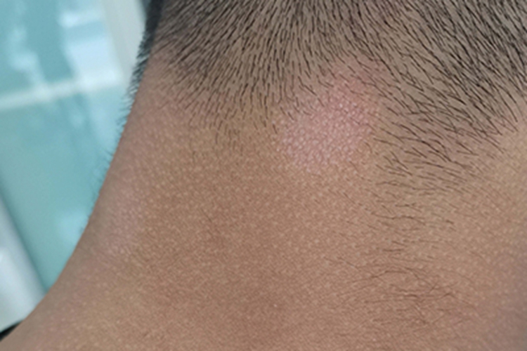 光泽苔藓后颈白斑图