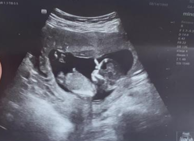 13周超声图 13周超声图